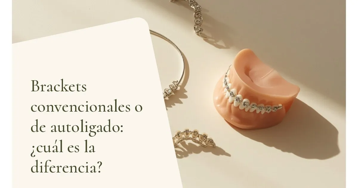 Brackets de ortodoncia y arco metálico sobre una superficie clara — portada del artículo 'Brackets convencionales o de autoligado: ¿cuál es la diferencia?', del consultorio de la Dra. Cléo Salustiano, dentista en la Mooca, São Paulo.