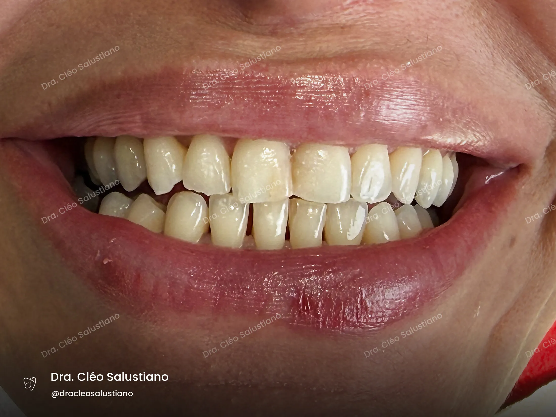 Facetas em resina na Mooca, São Paulo — antes (caso 1) — Dra. Cléo Salustiano