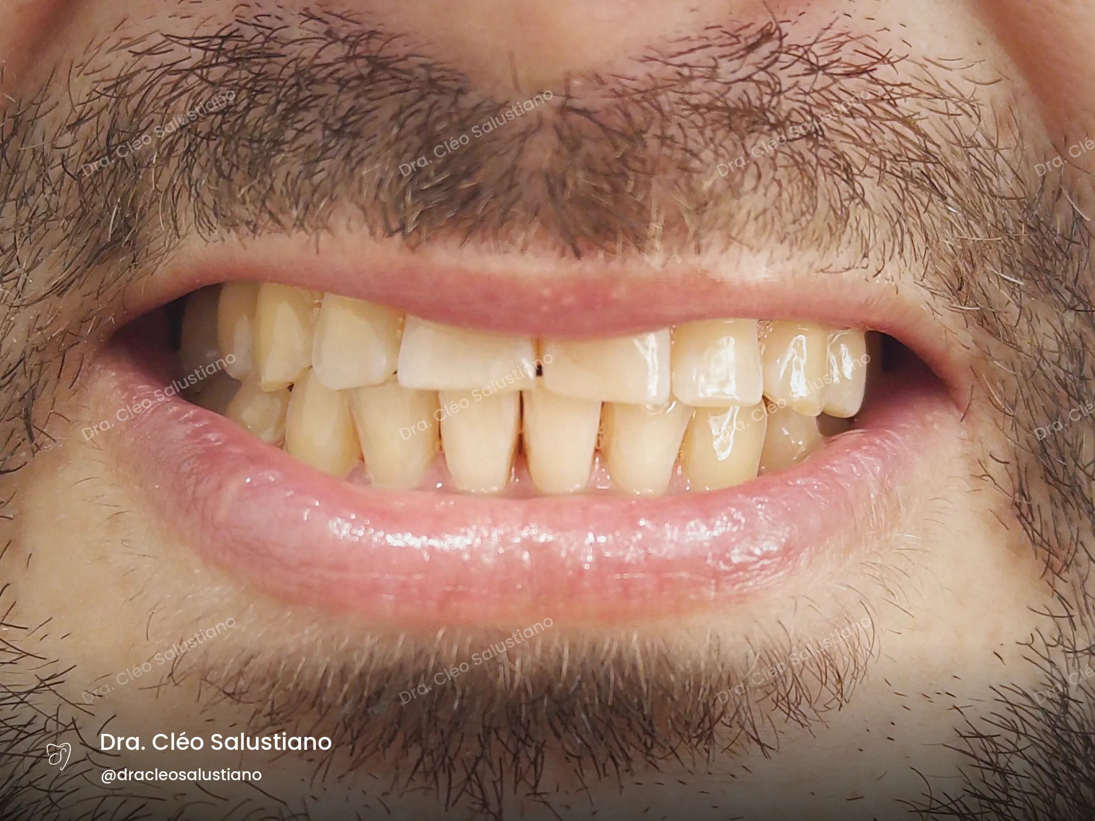 Facetas em resina na Mooca, São Paulo — antes (caso 2) — Dra. Cléo Salustiano
