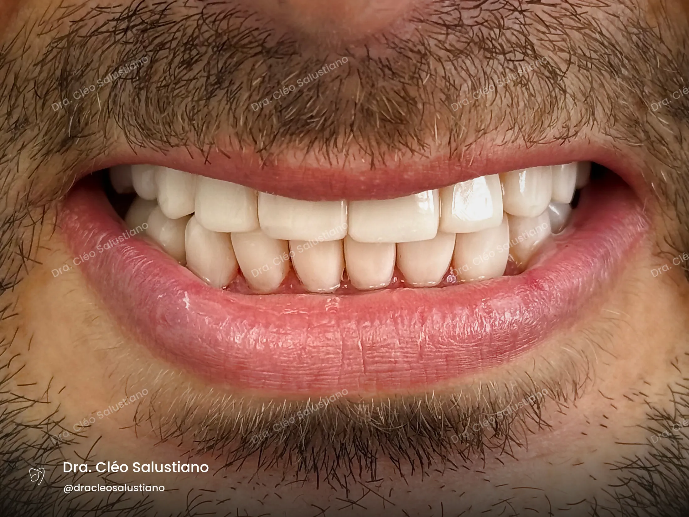 Facetas em resina na Mooca, São Paulo — depois (caso 2) — Dra. Cléo Salustiano