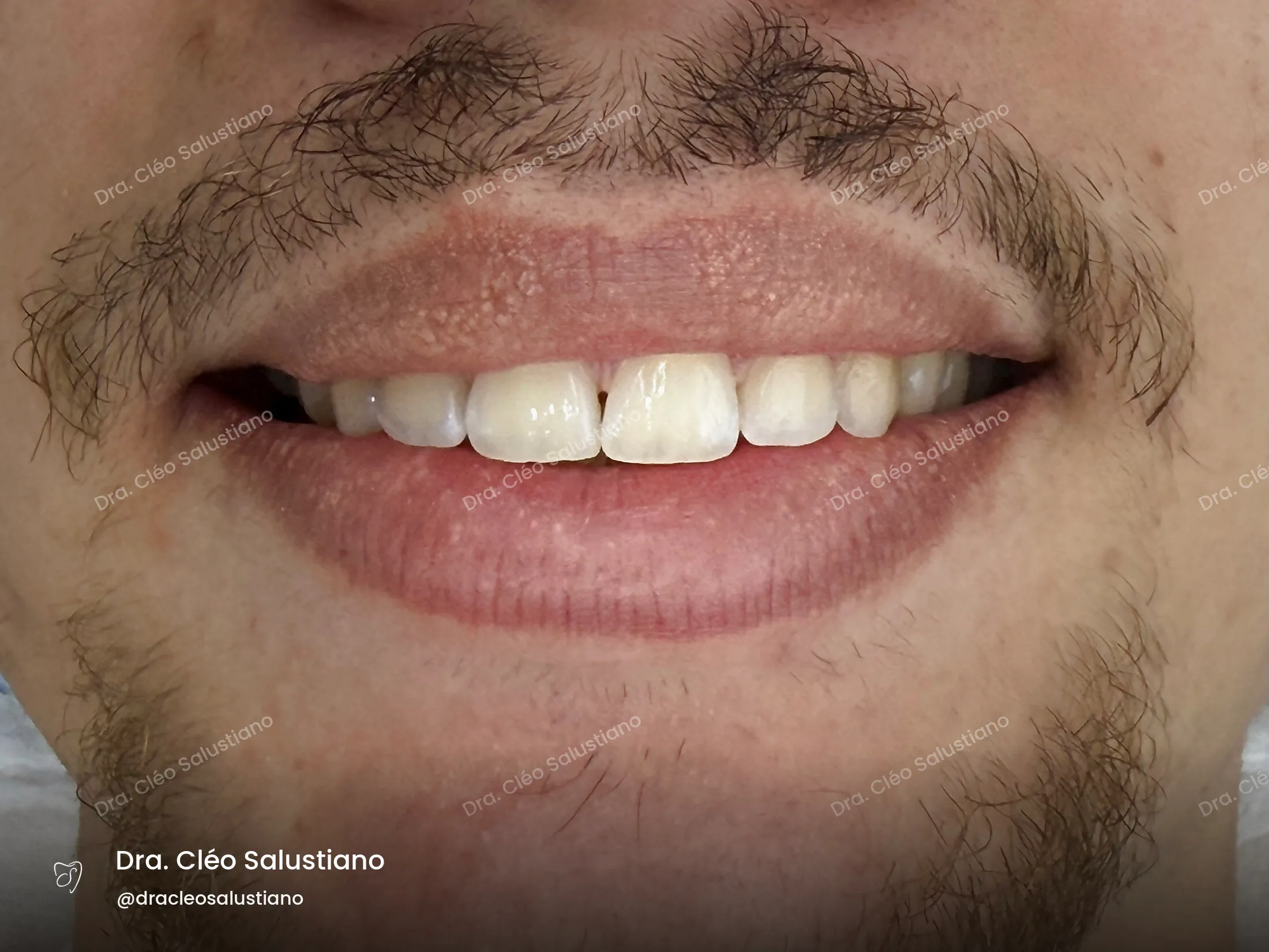 Facetas em resina na Mooca, São Paulo — antes (caso 3) — Dra. Cléo Salustiano