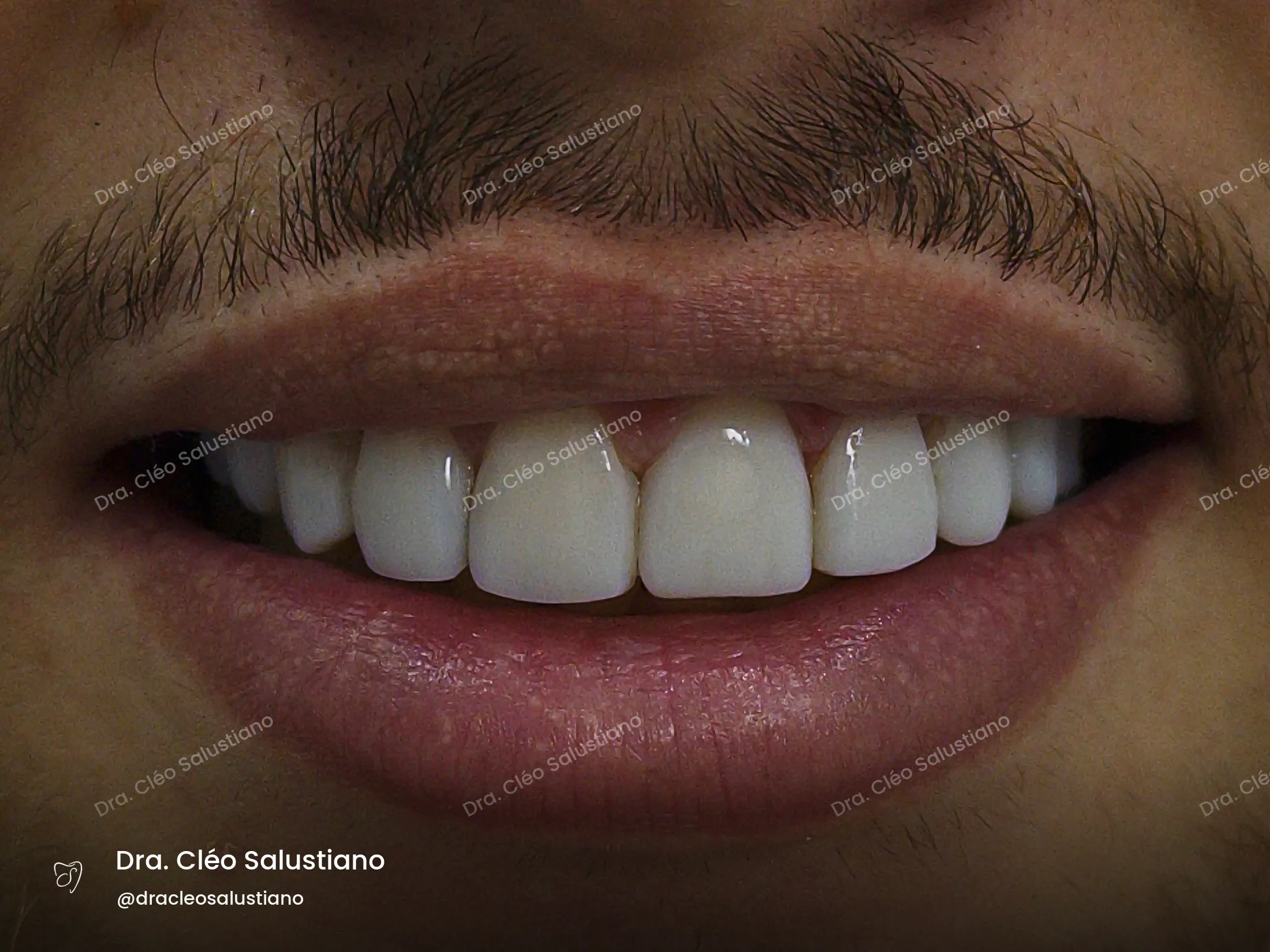 Facetas em resina na Mooca, São Paulo — depois (caso 3) — Dra. Cléo Salustiano