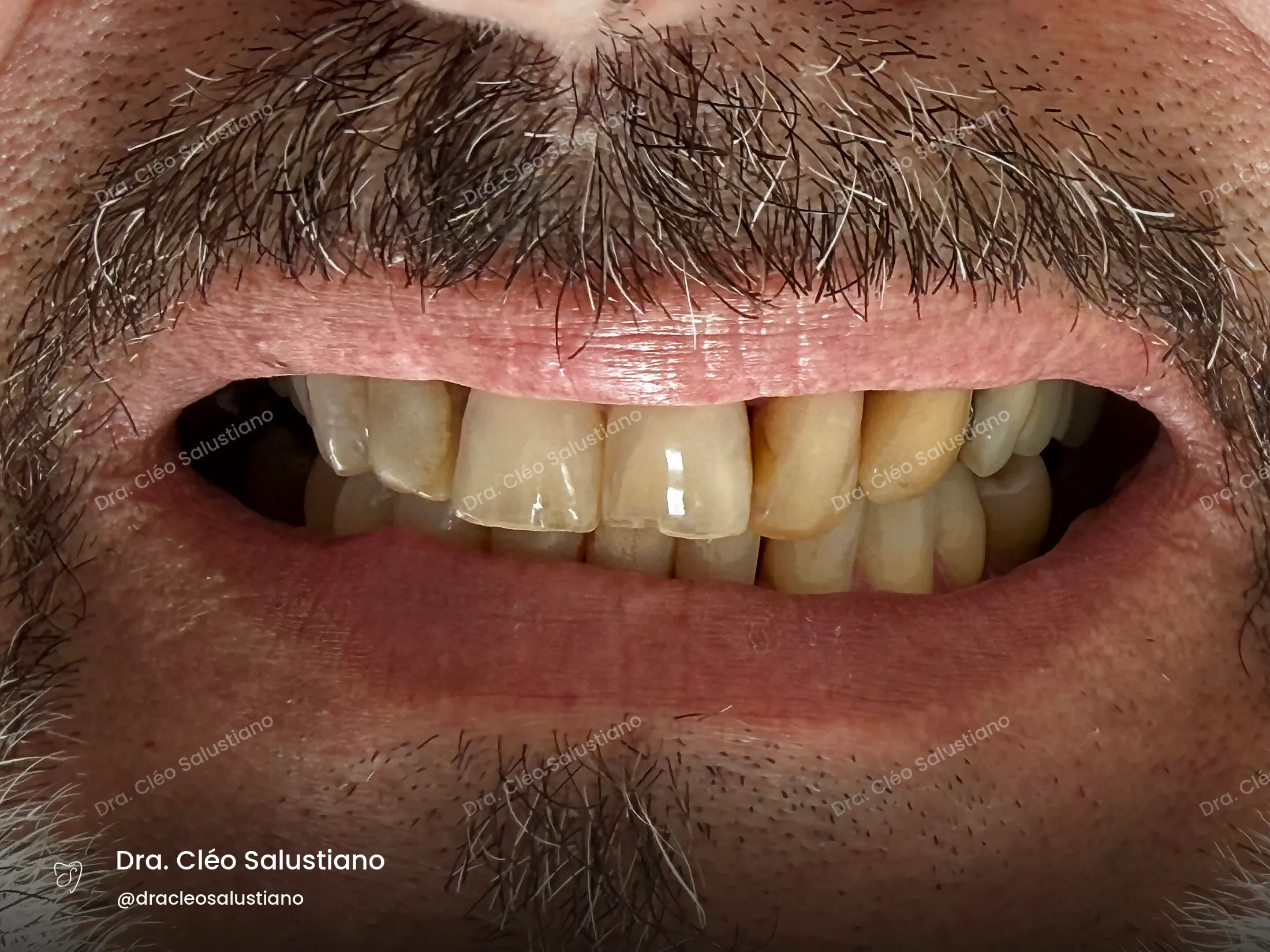 Facetas em resina na Mooca, São Paulo — antes (caso 4) — Dra. Cléo Salustiano