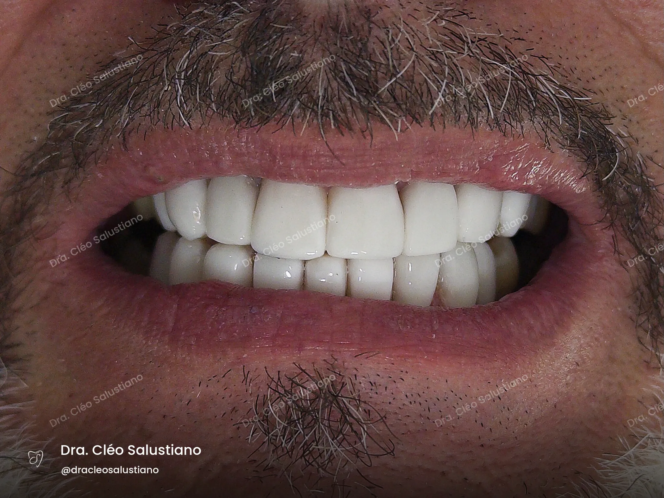 Facetas em resina na Mooca, São Paulo — depois (caso 4) — Dra. Cléo Salustiano
