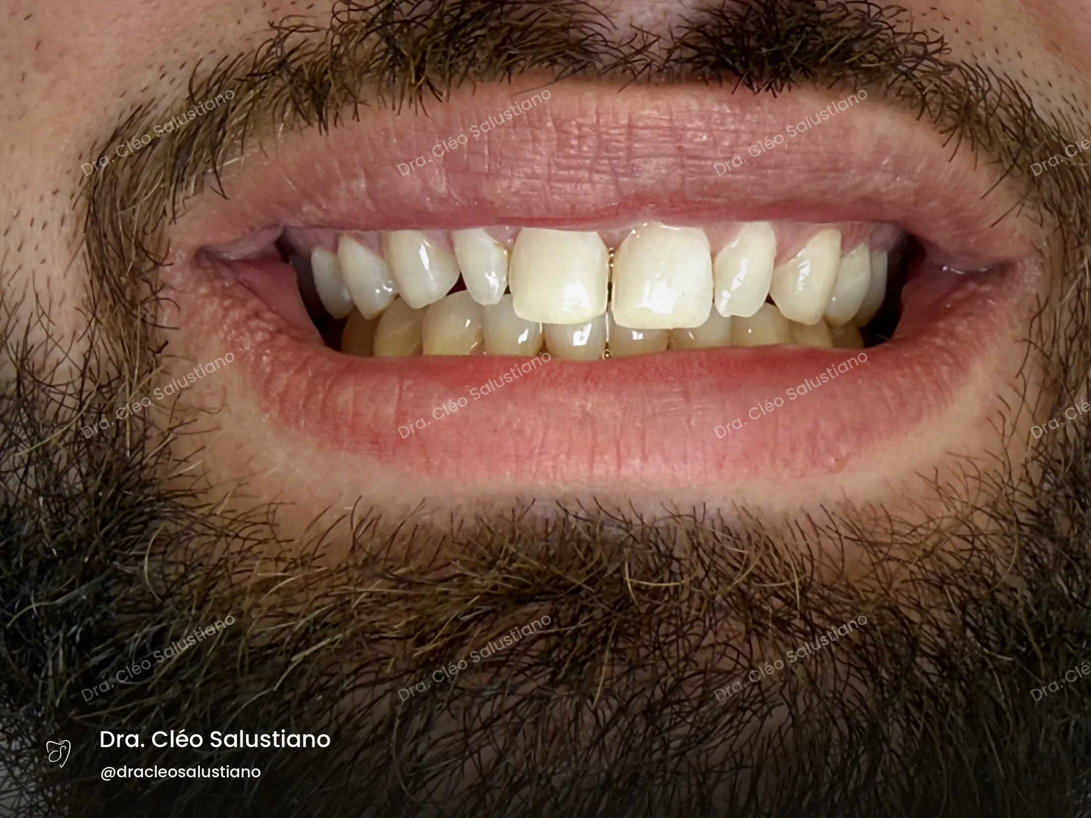 Facetas em resina na Mooca, São Paulo — antes (caso 5) — Dra. Cléo Salustiano