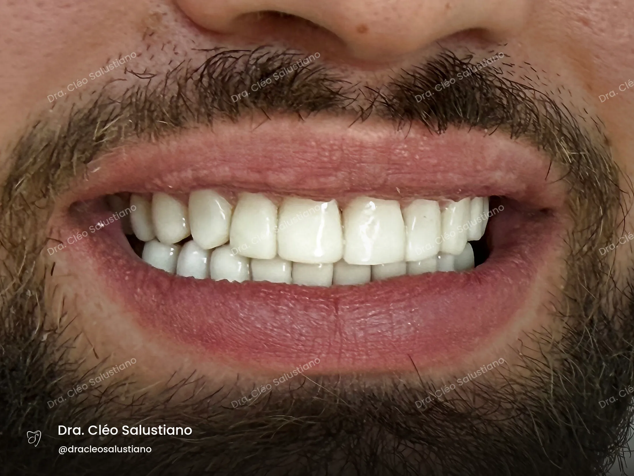 Facetas em resina na Mooca, São Paulo — depois (caso 5) — Dra. Cléo Salustiano