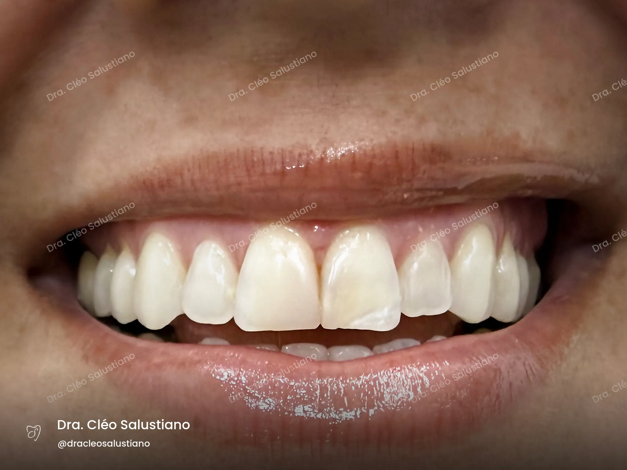 Facetas em resina na Mooca, São Paulo — antes (caso 6) — Dra. Cléo Salustiano