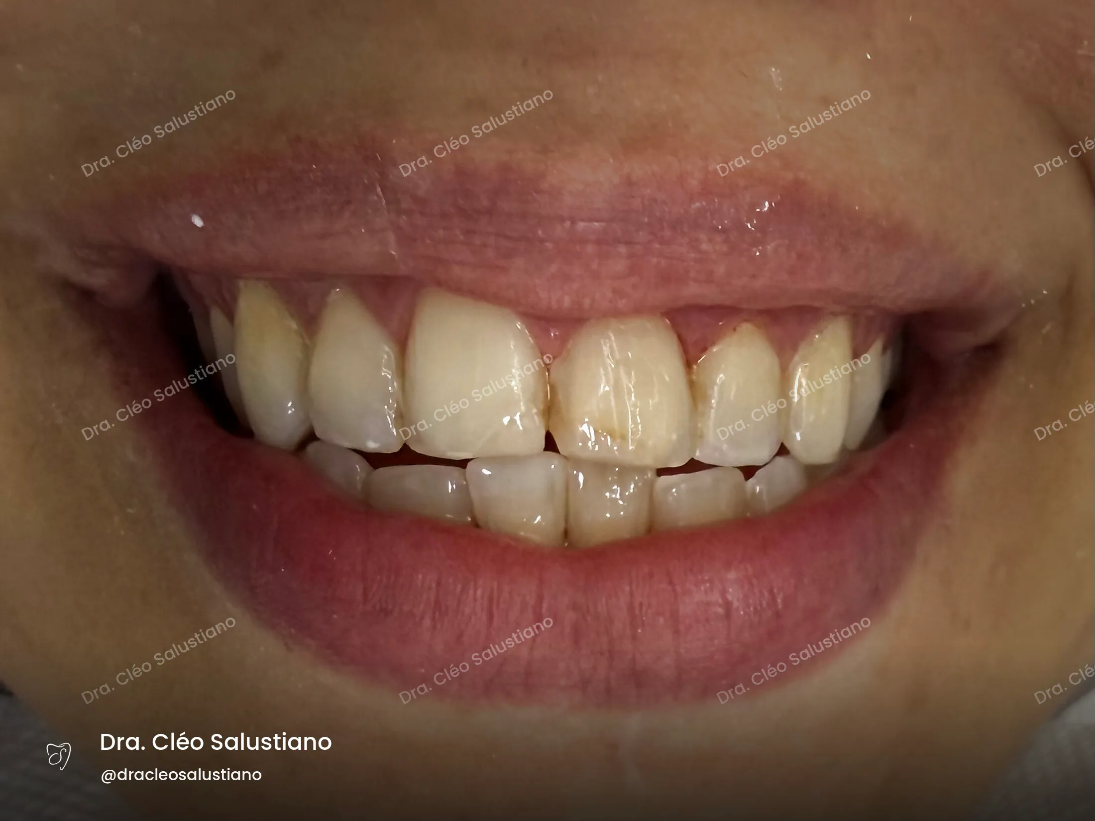 Facetas em resina na Mooca, São Paulo — antes (caso 7) — Dra. Cléo Salustiano