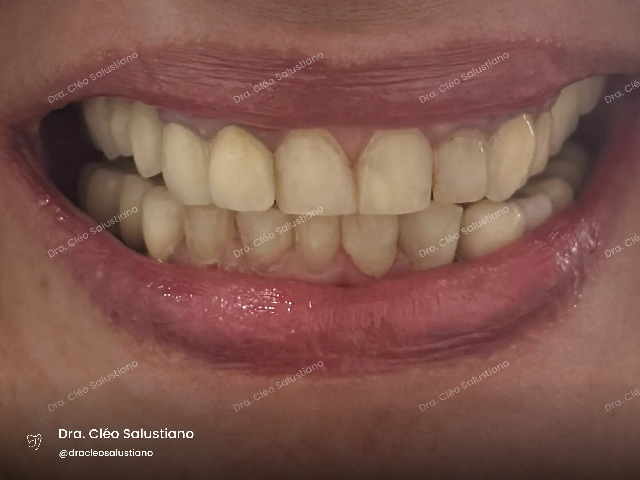 Facetas em resina na Mooca, São Paulo — antes (caso 8) — Dra. Cléo Salustiano