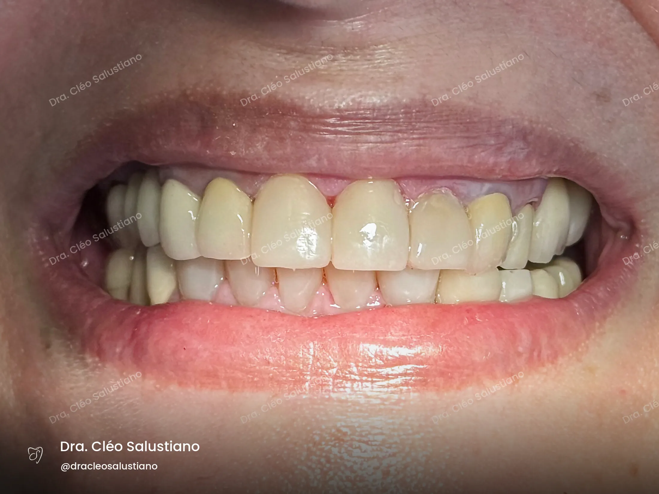 Facetas em resina na Mooca, São Paulo — depois (caso 8) — Dra. Cléo Salustiano