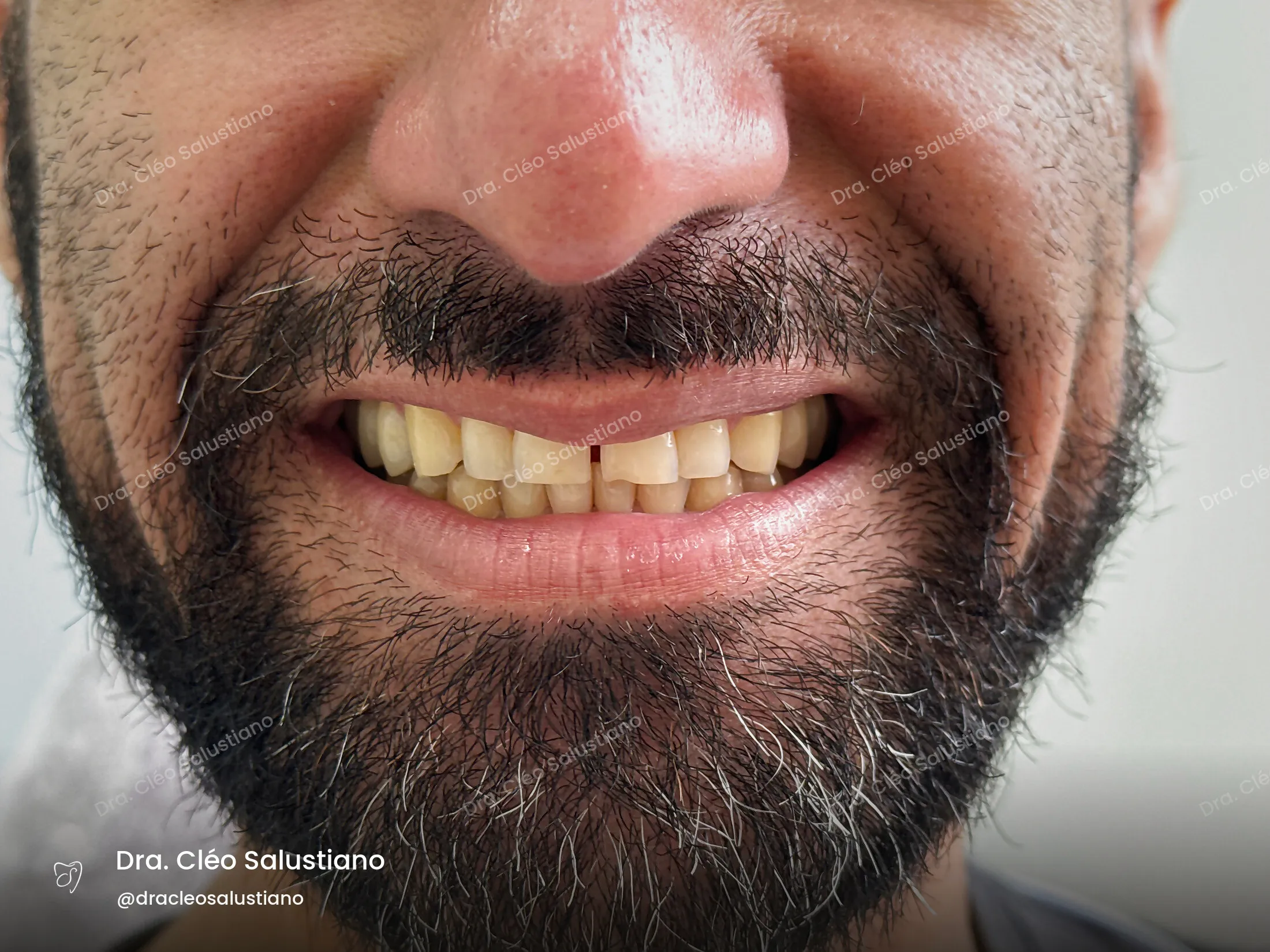 Facetas em resina na Mooca, São Paulo — antes (caso 9) — Dra. Cléo Salustiano