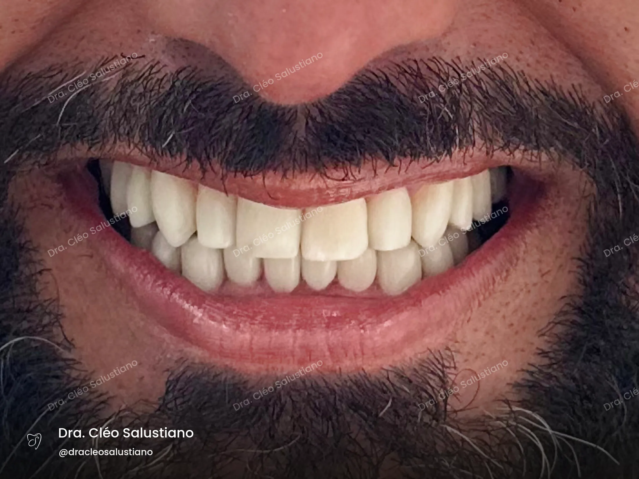 Facetas em resina na Mooca, São Paulo — depois (caso 9) — Dra. Cléo Salustiano
