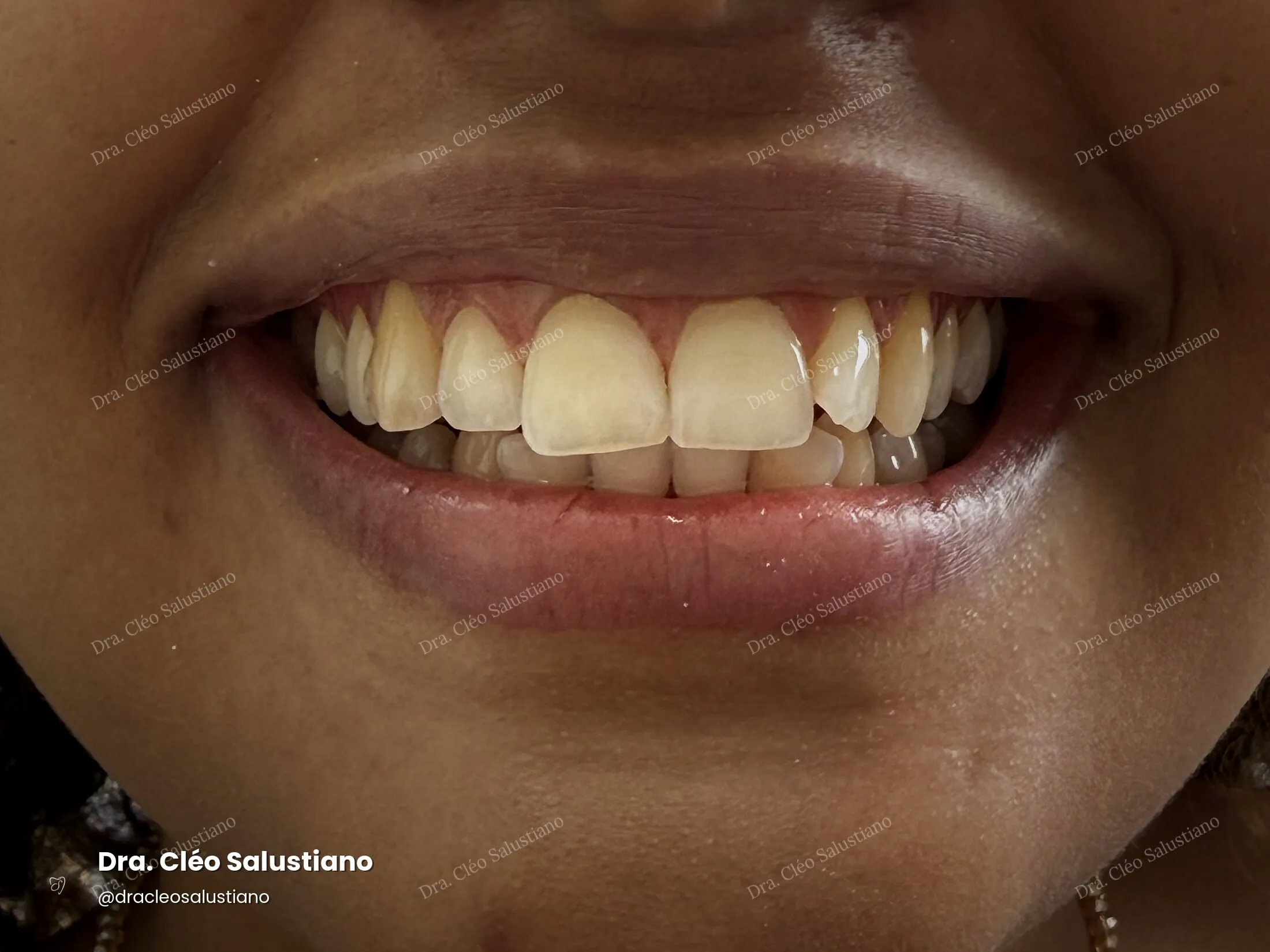 Clareamento dental na Mooca, São Paulo — antes (caso 1) — Dra. Cléo Salustiano