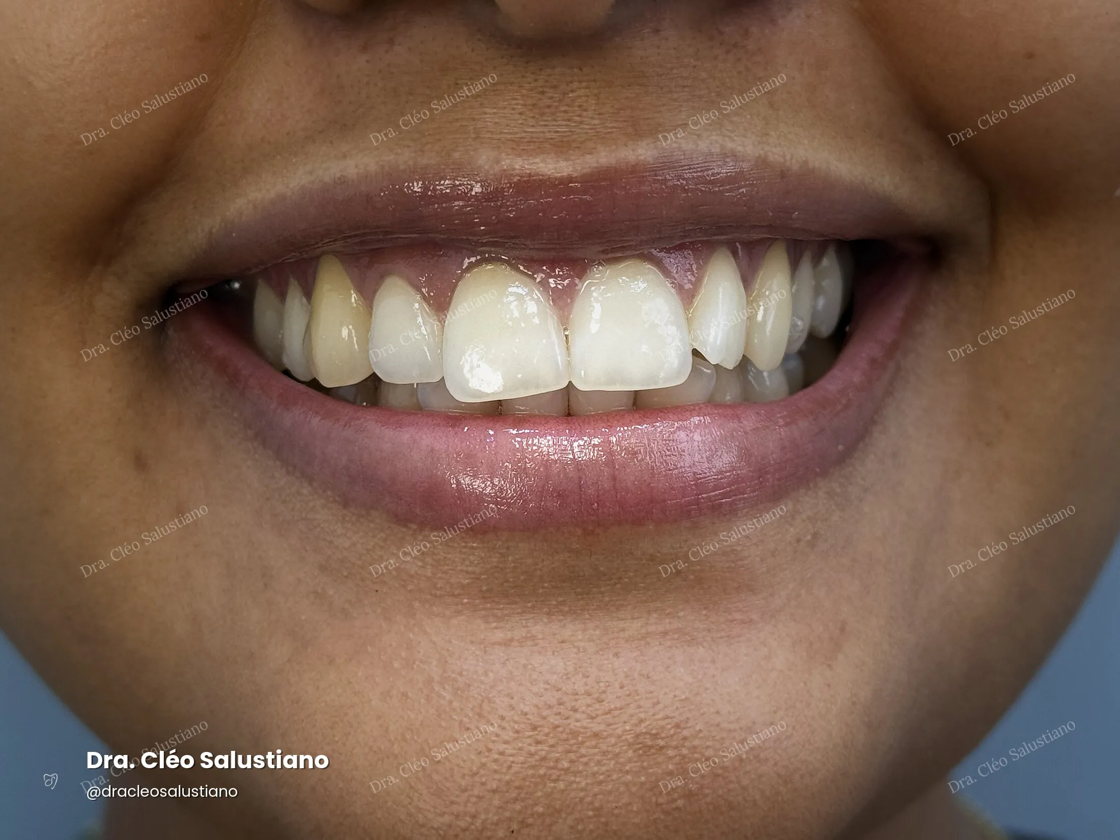 Clareamento dental na Mooca, São Paulo — depois (caso 1) — Dra. Cléo Salustiano