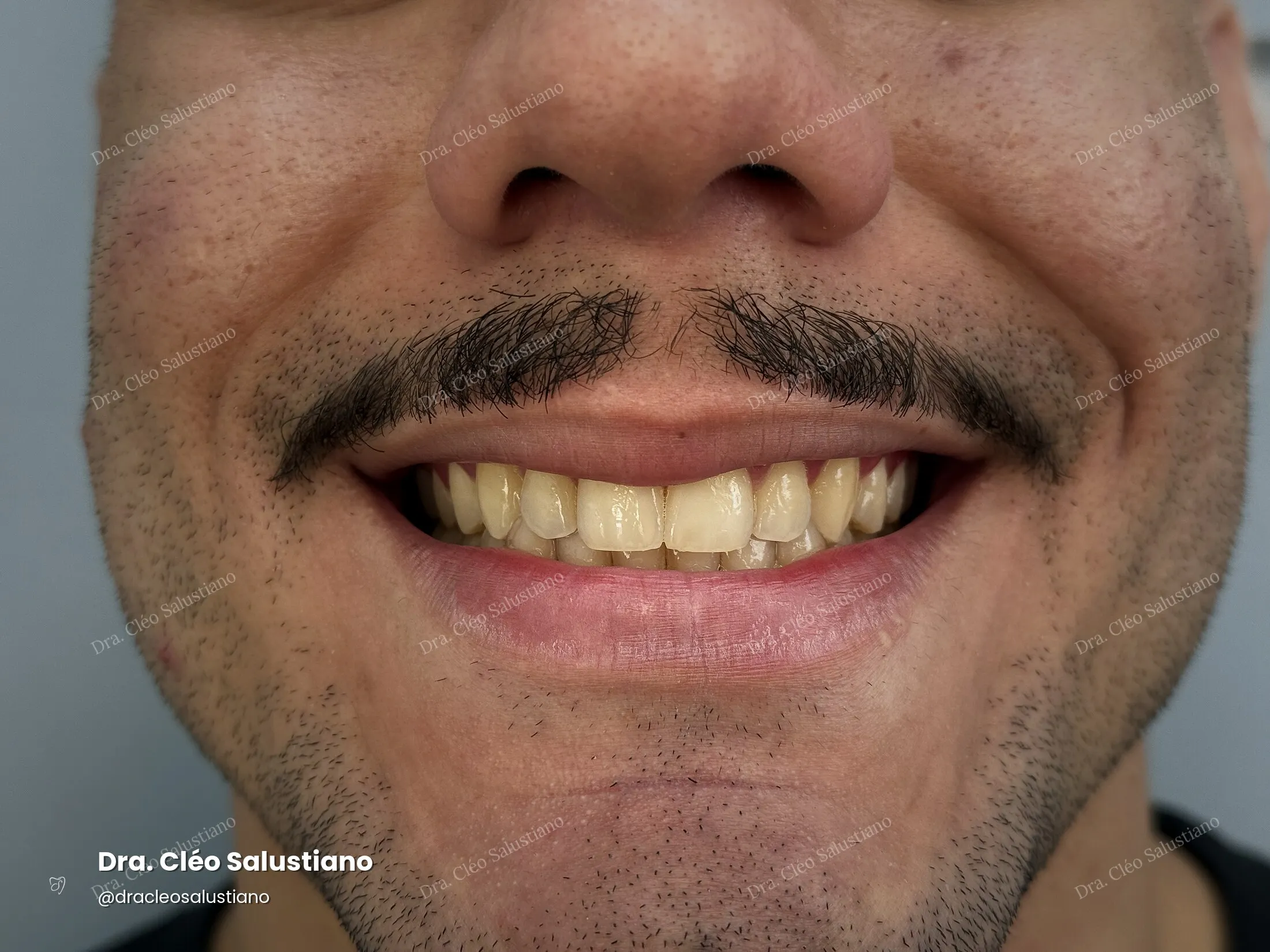 Clareamento dental na Mooca, São Paulo — antes (caso 2) — Dra. Cléo Salustiano
