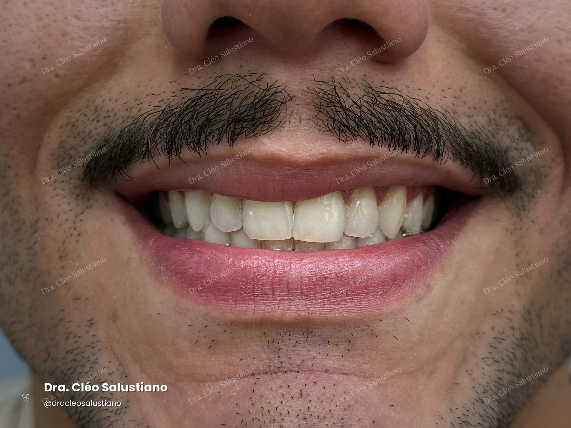 Clareamento dental na Mooca, São Paulo — depois (caso 2) — Dra. Cléo Salustiano