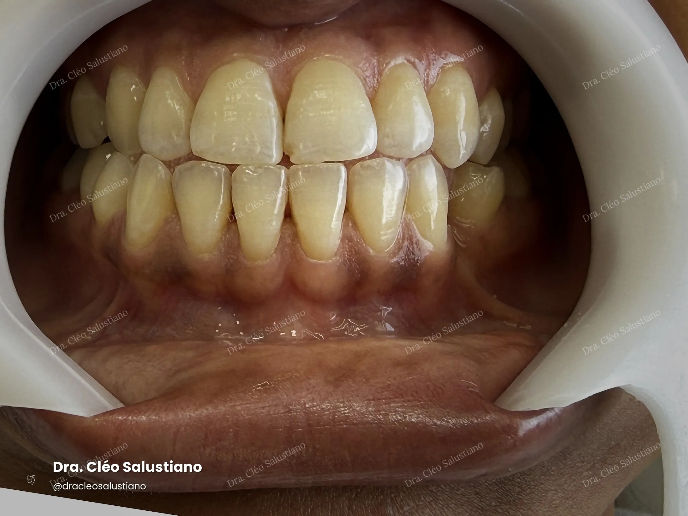 Clareamento dental na Mooca, São Paulo — antes (caso 3) — Dra. Cléo Salustiano