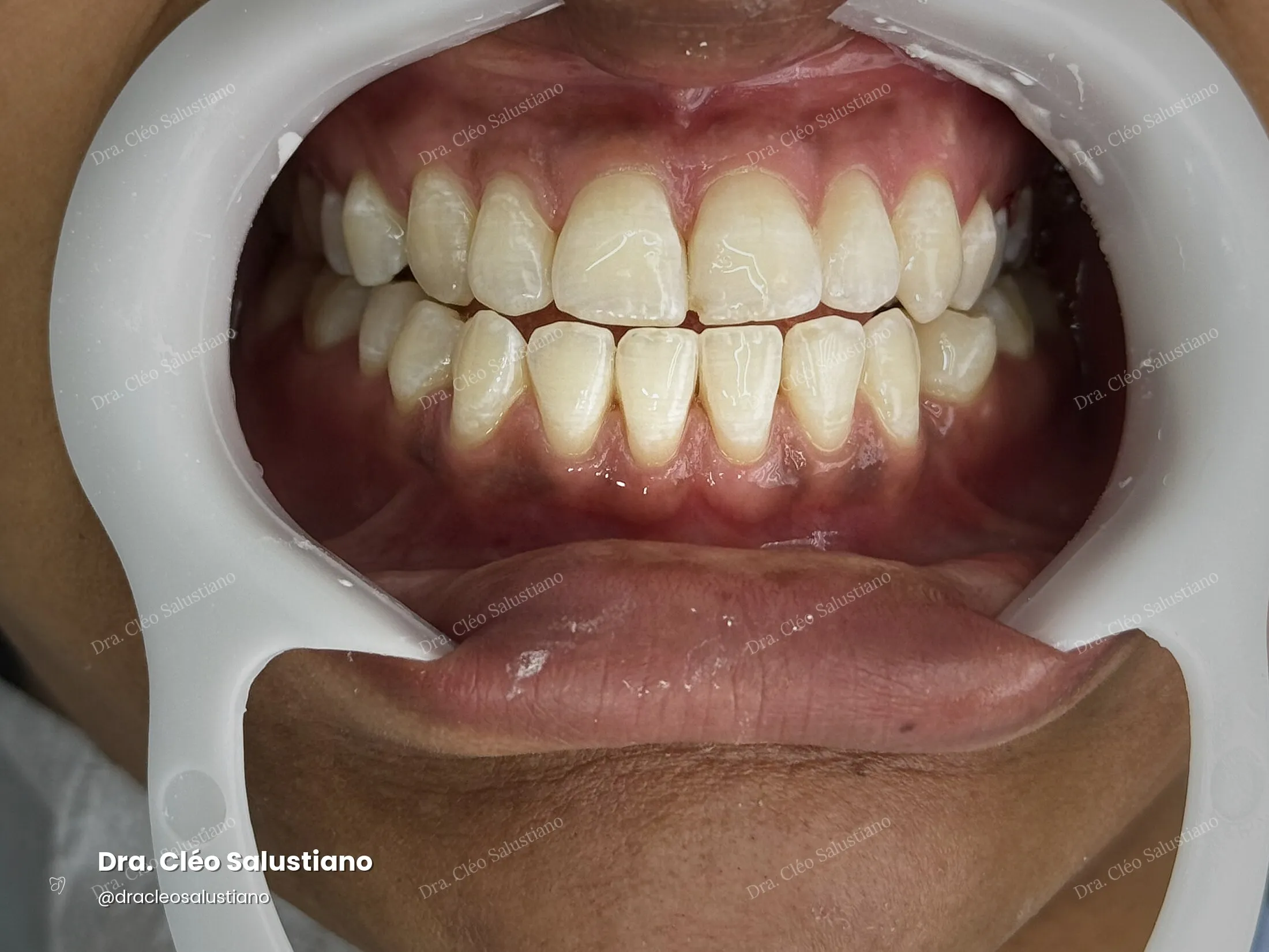 Clareamento dental na Mooca, São Paulo — depois (caso 3) — Dra. Cléo Salustiano