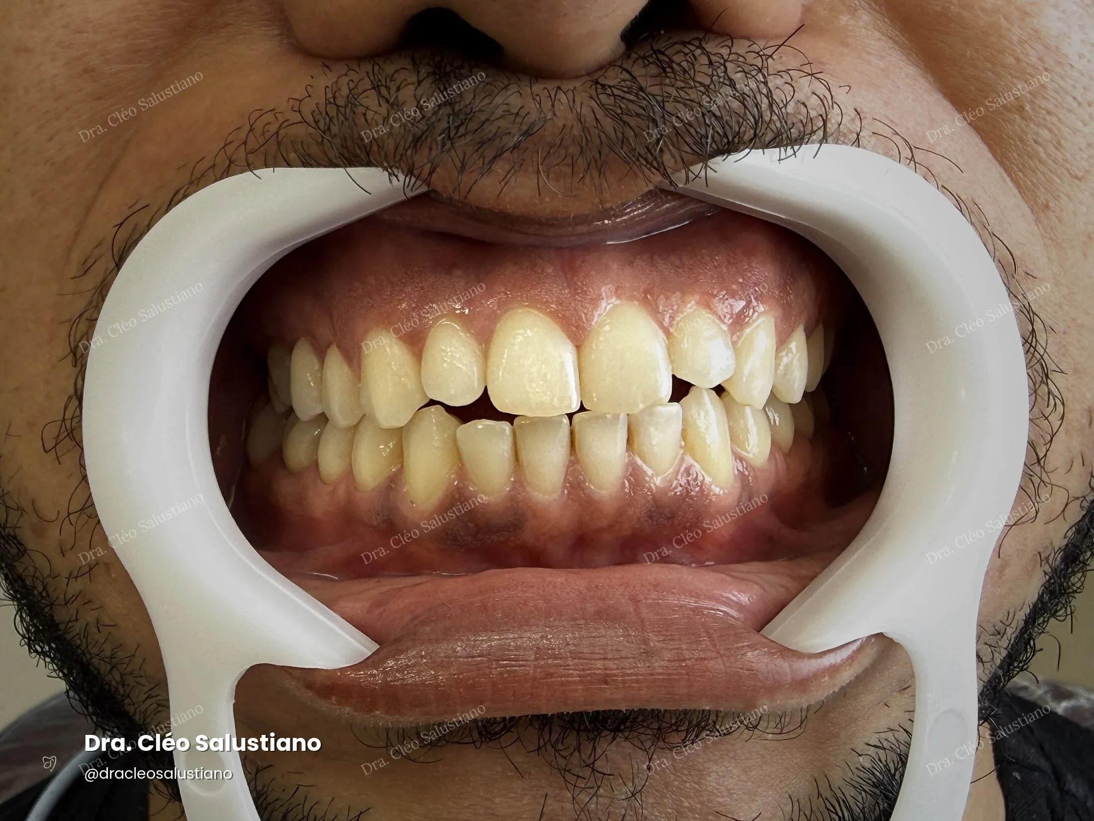 Clareamento dental na Mooca, São Paulo — antes (caso 4) — Dra. Cléo Salustiano