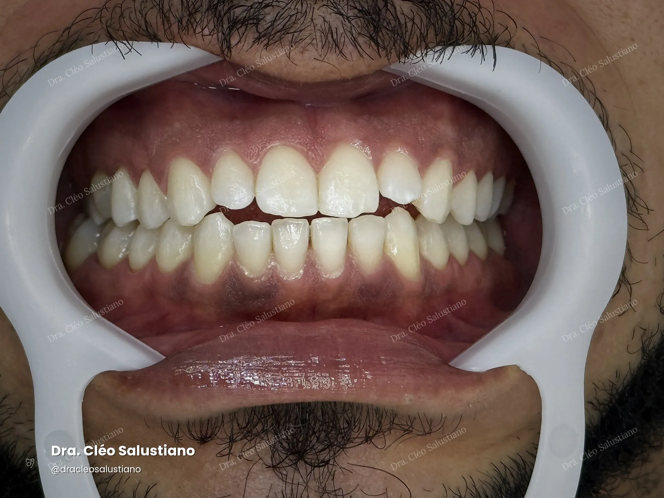 Clareamento dental na Mooca, São Paulo — depois (caso 4) — Dra. Cléo Salustiano