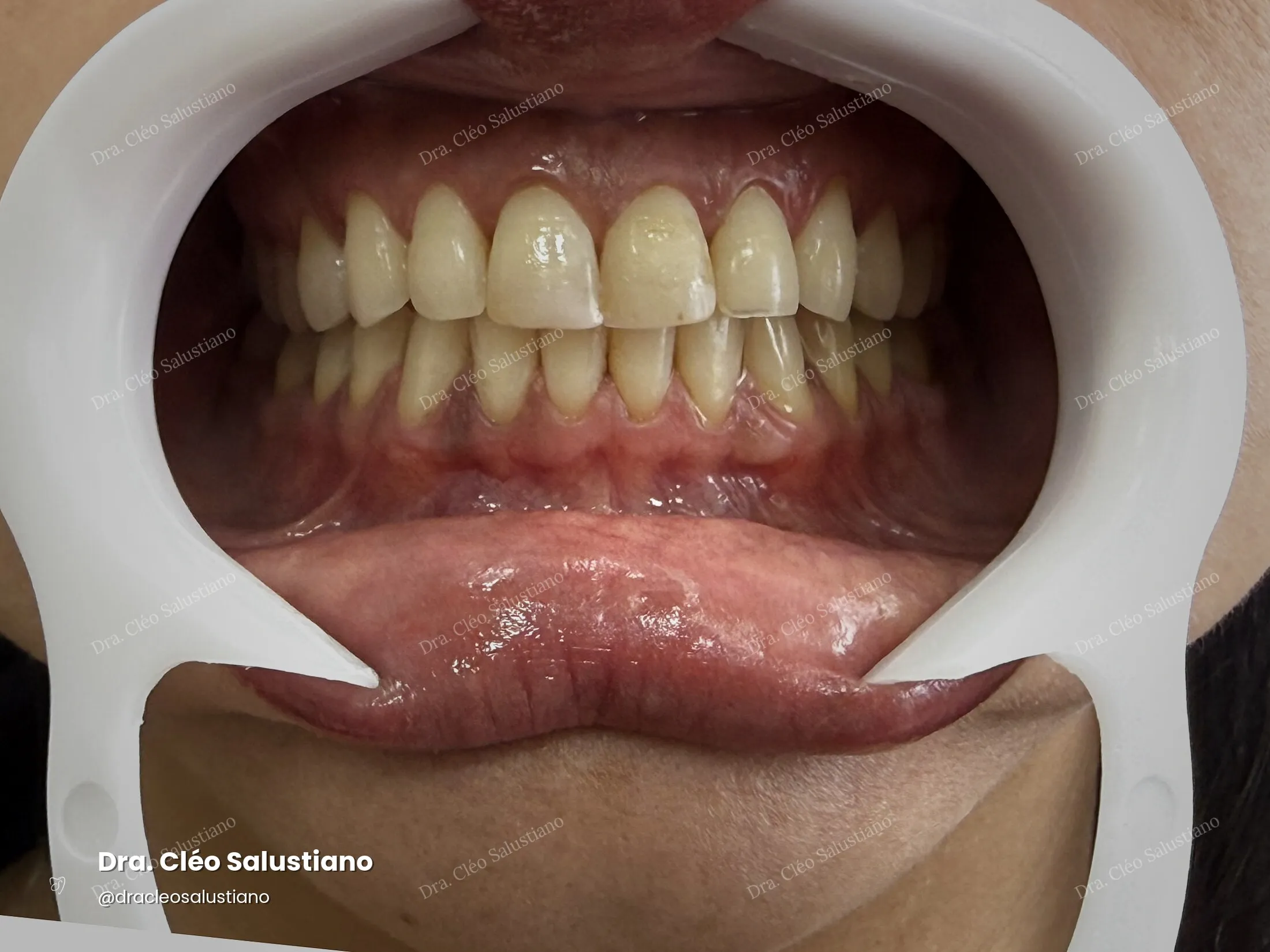 Clareamento dental na Mooca, São Paulo — antes (caso 5) — Dra. Cléo Salustiano