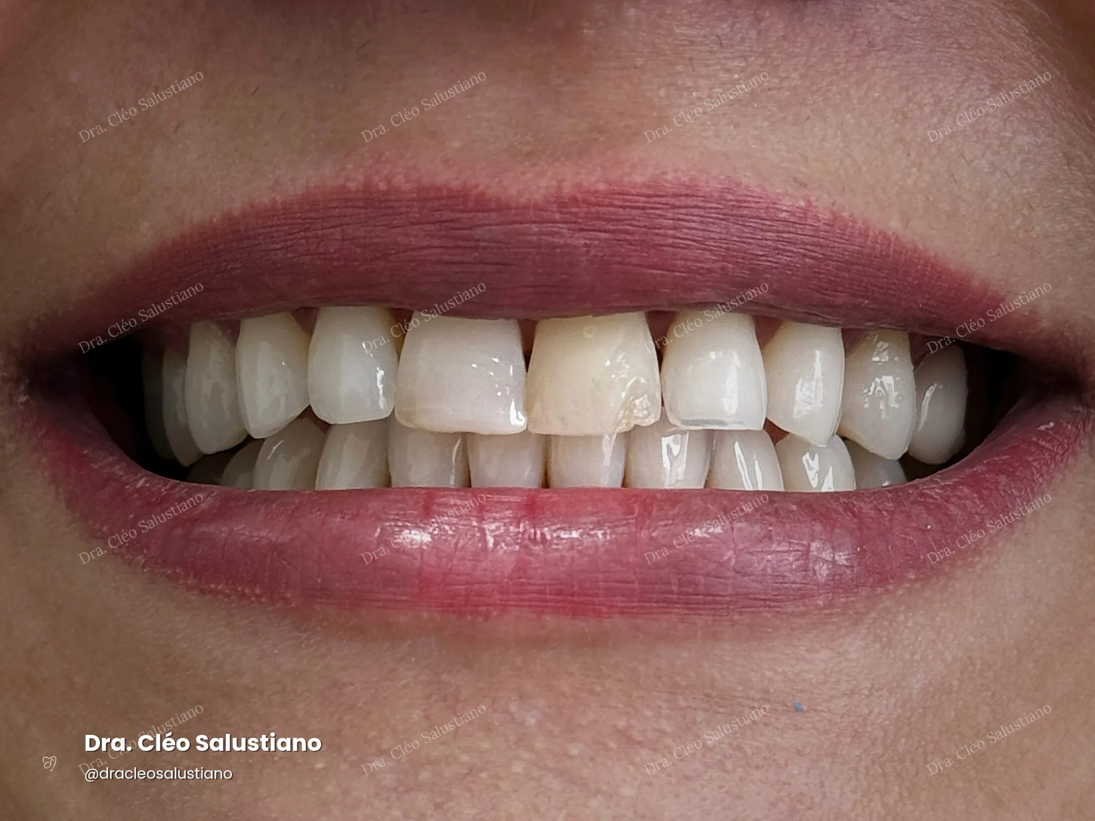 Clareamento dental na Mooca, São Paulo — depois (caso 5) — Dra. Cléo Salustiano