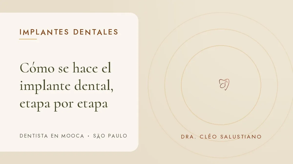 Objetos de odontología sobre una superficie clara — portada del artículo 'Cómo se hace el implante dental, etapa por etapa', del consultorio de la Dra. Cléo Salustiano, dentista en Mooca, São Paulo.