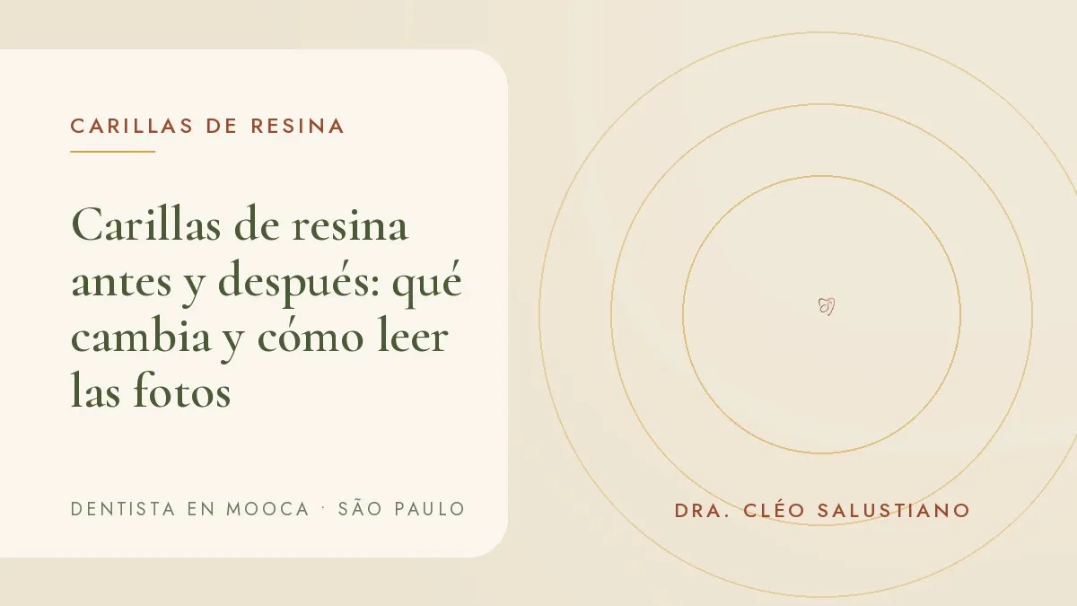 Sonrisa fotografiada en el consultorio, con retractor labial, para documentar carillas de resina — portada del artículo 'Carillas de resina antes y después: qué cambia y cómo leer las fotos', del consultorio de la Dra. Cléo Salustiano, dentista en Mooca, São Paulo.