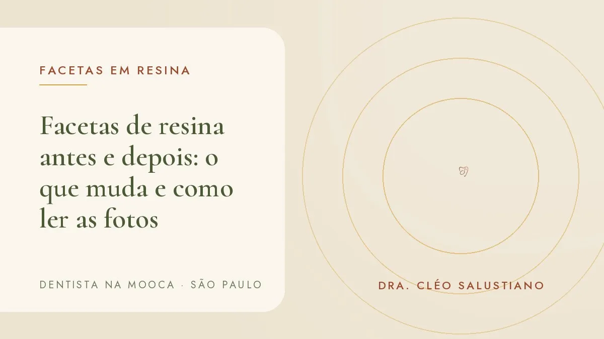 Sorriso fotografado em consultório, com afastador labial, para documentar facetas de resina — capa do artigo 'Facetas de resina antes e depois: o que muda e como ler as fotos', do consultório da Dra. Cléo Salustiano, dentista na Mooca, São Paulo.